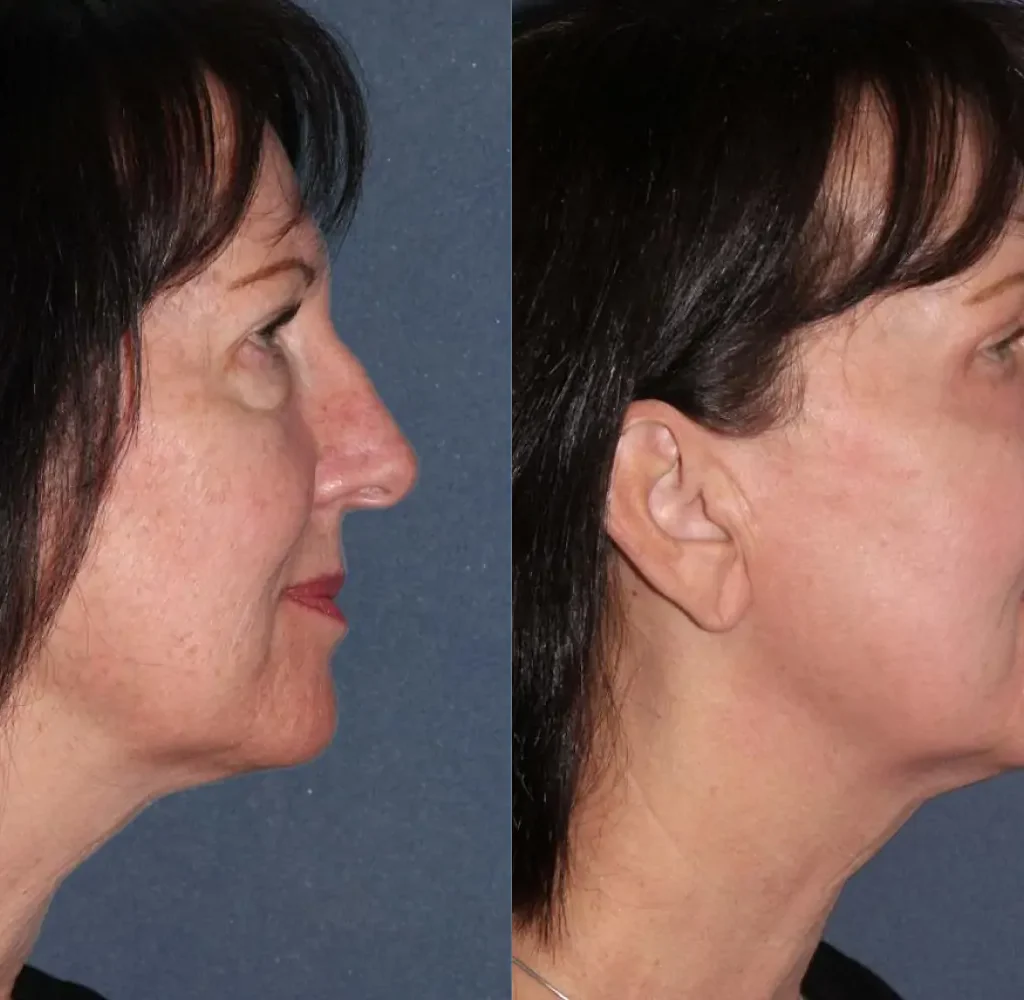 Natural results with Botox and fillers in Riyadh