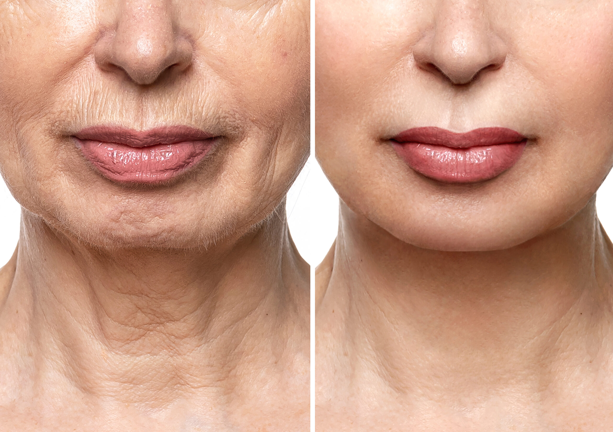 Dermal Fillers for Natural Volume Restoration | Reveal Clinics Riyadh