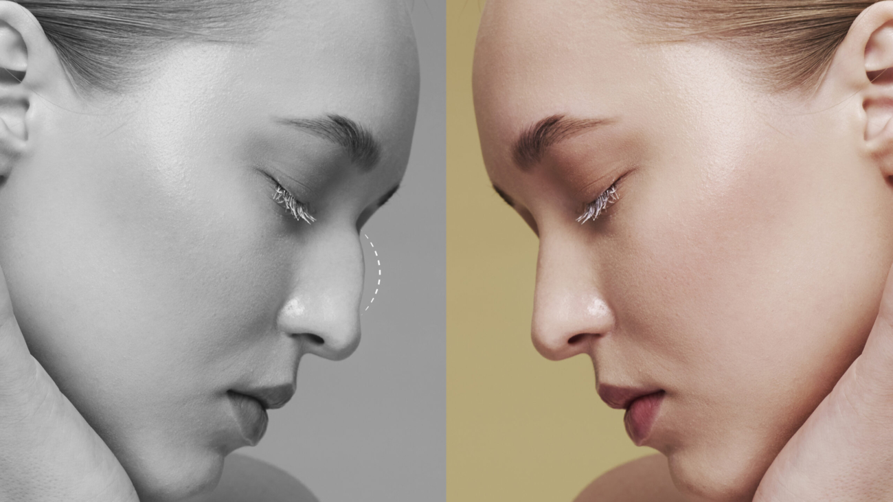 Liquid Rhinoplasty vs Surgical Rhinoplasty
