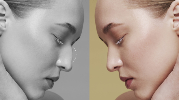 Liquid Rhinoplasty vs Surgical Rhinoplasty