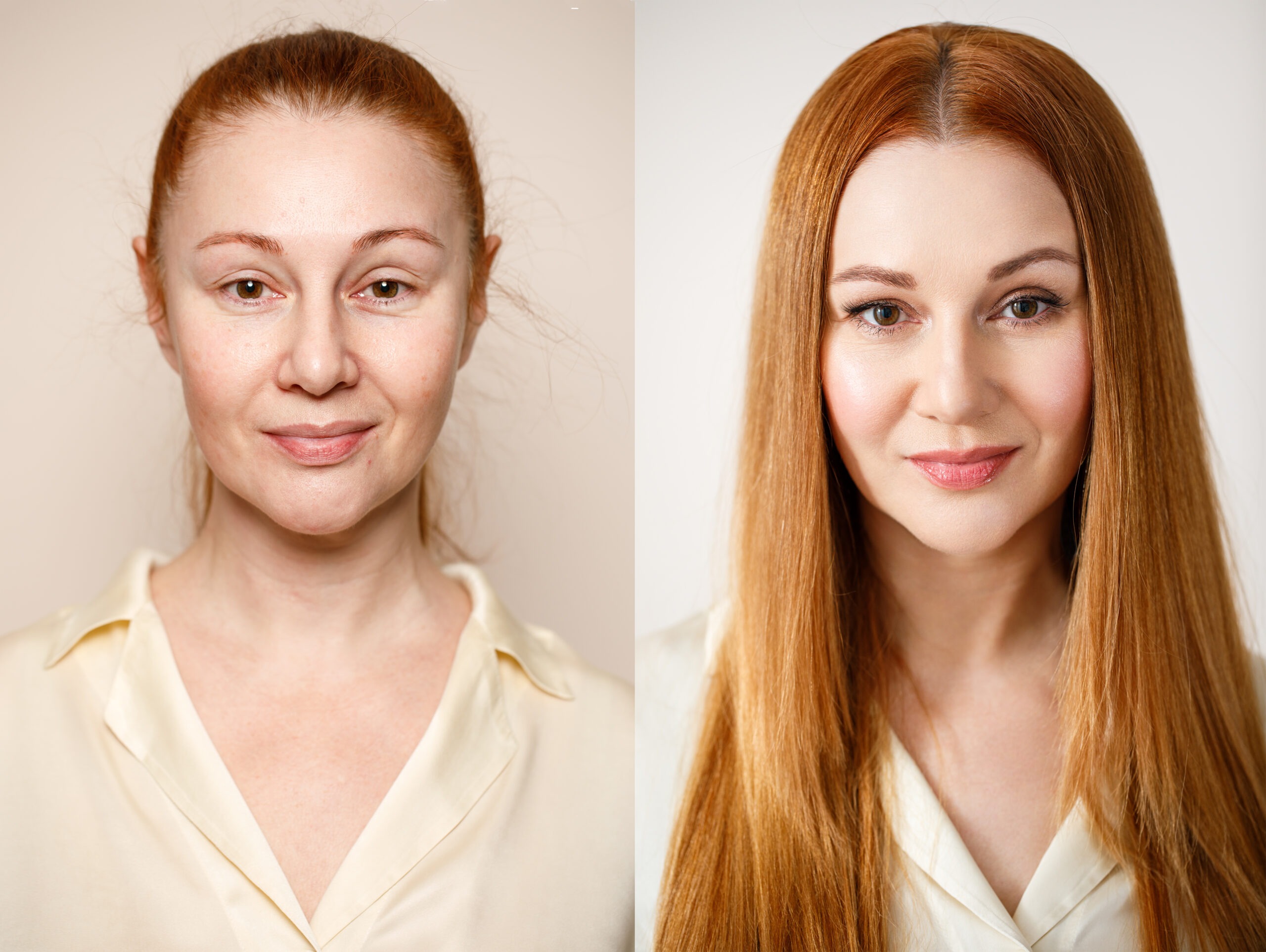 Before and After Sculptra Treatment