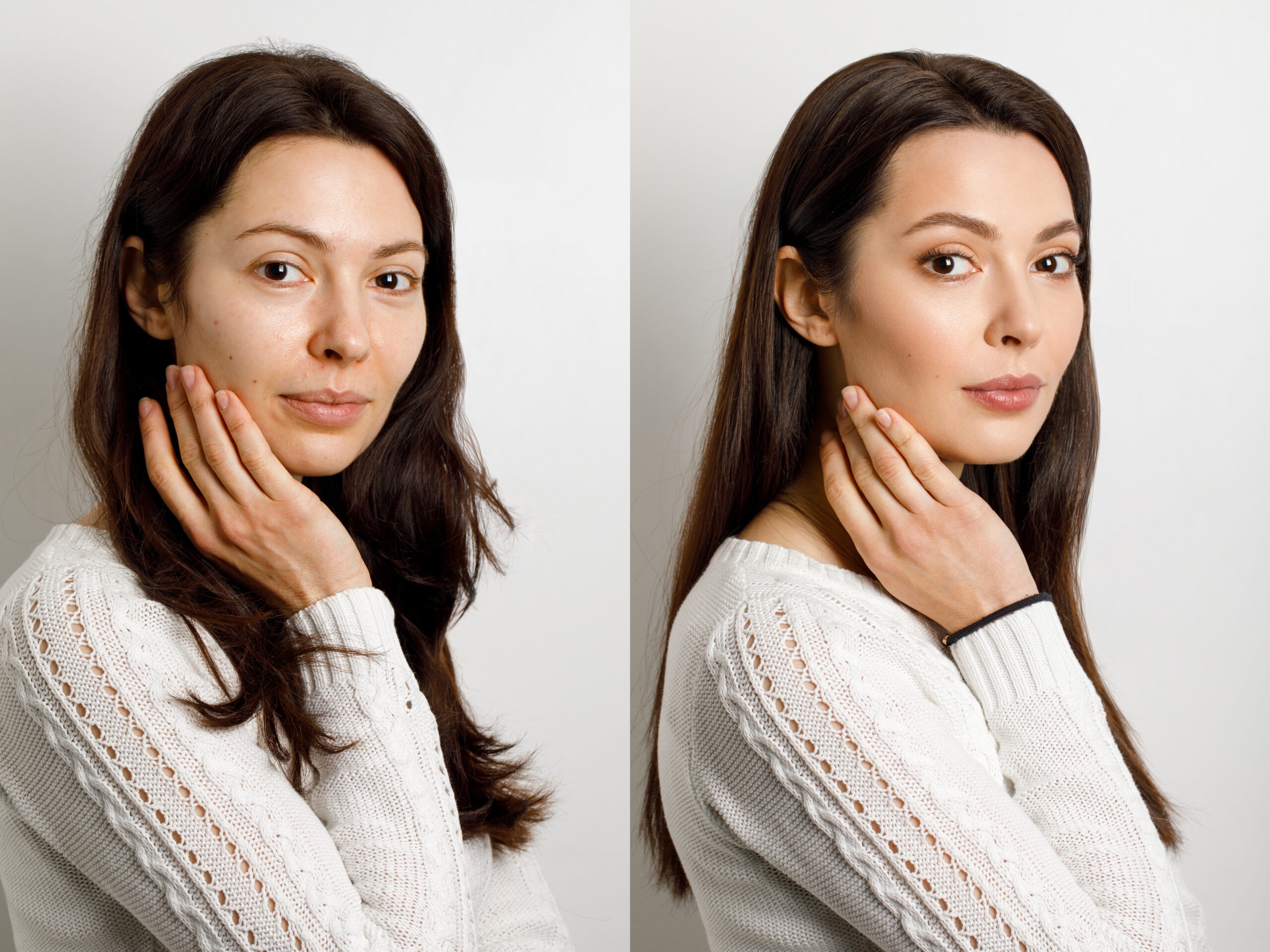 Before and after jawline contouring with fillers