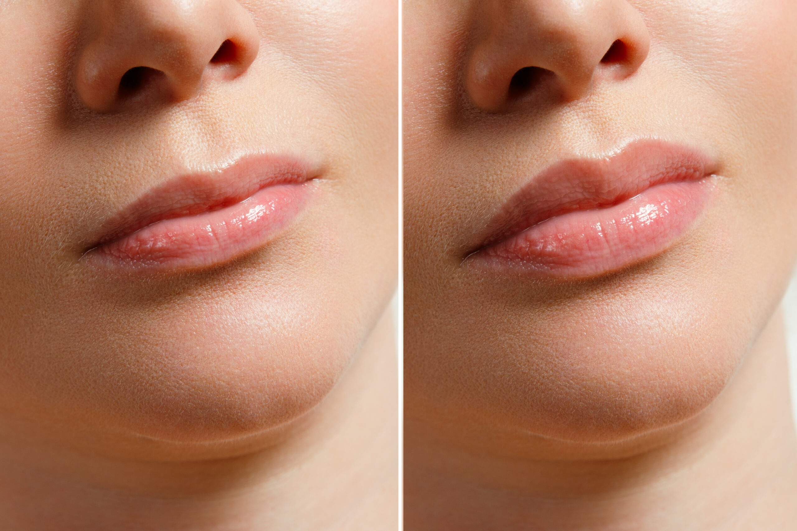 Before and after lip filler treatment