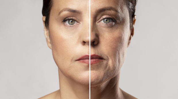 Before and after collagen-stimulating injectables