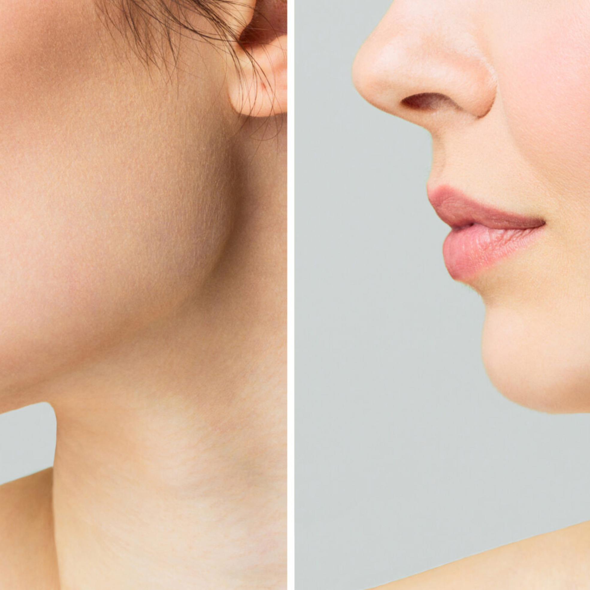 Before and after showing jawline contouring with Radiesse filler
