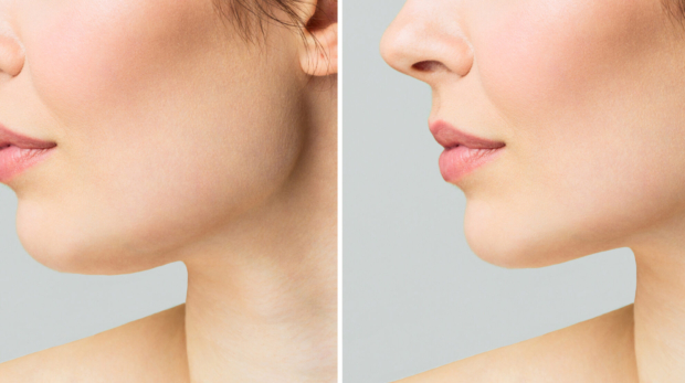 Before and after showing jawline contouring with Radiesse filler