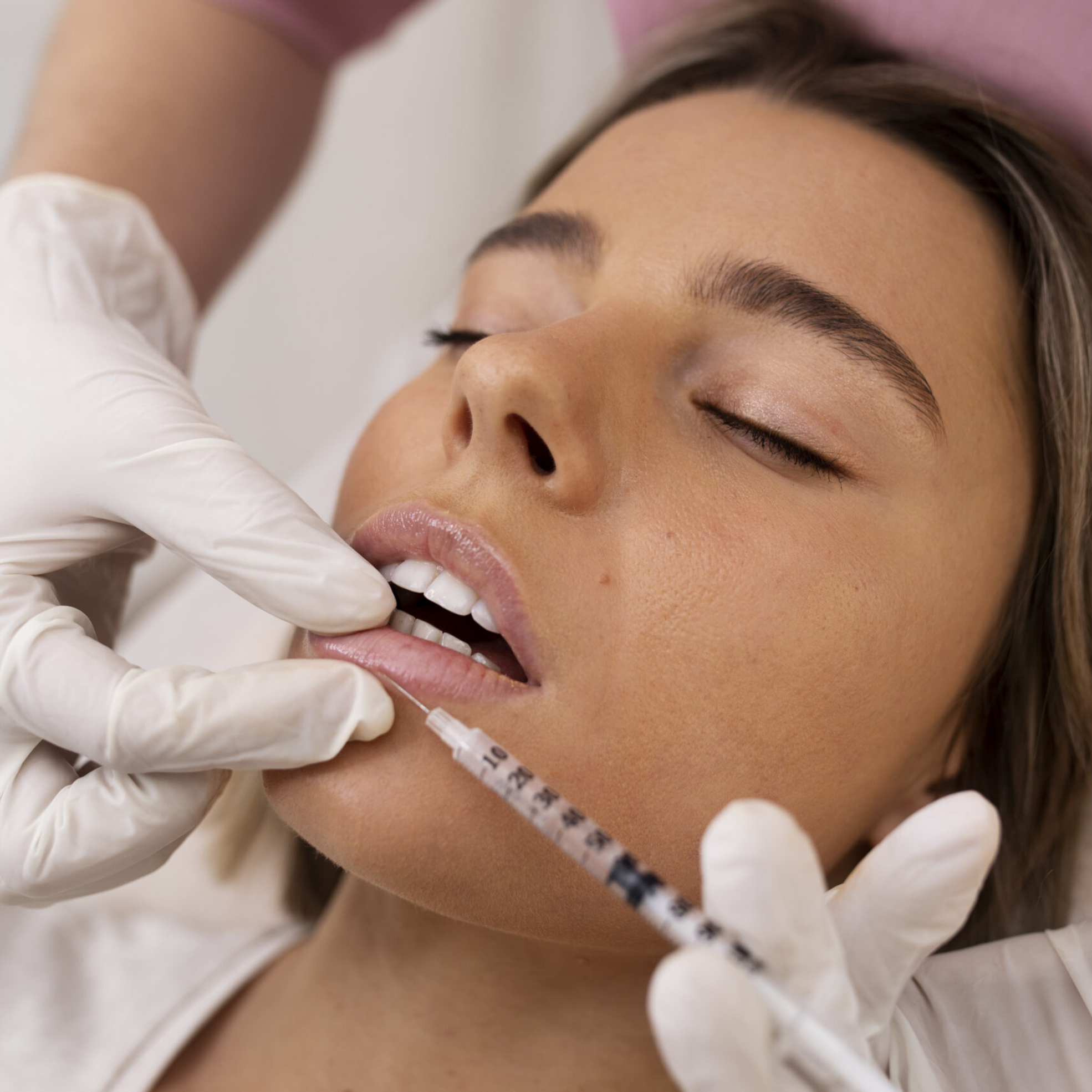 Natural lip enhancement using hyaluronic acid filler