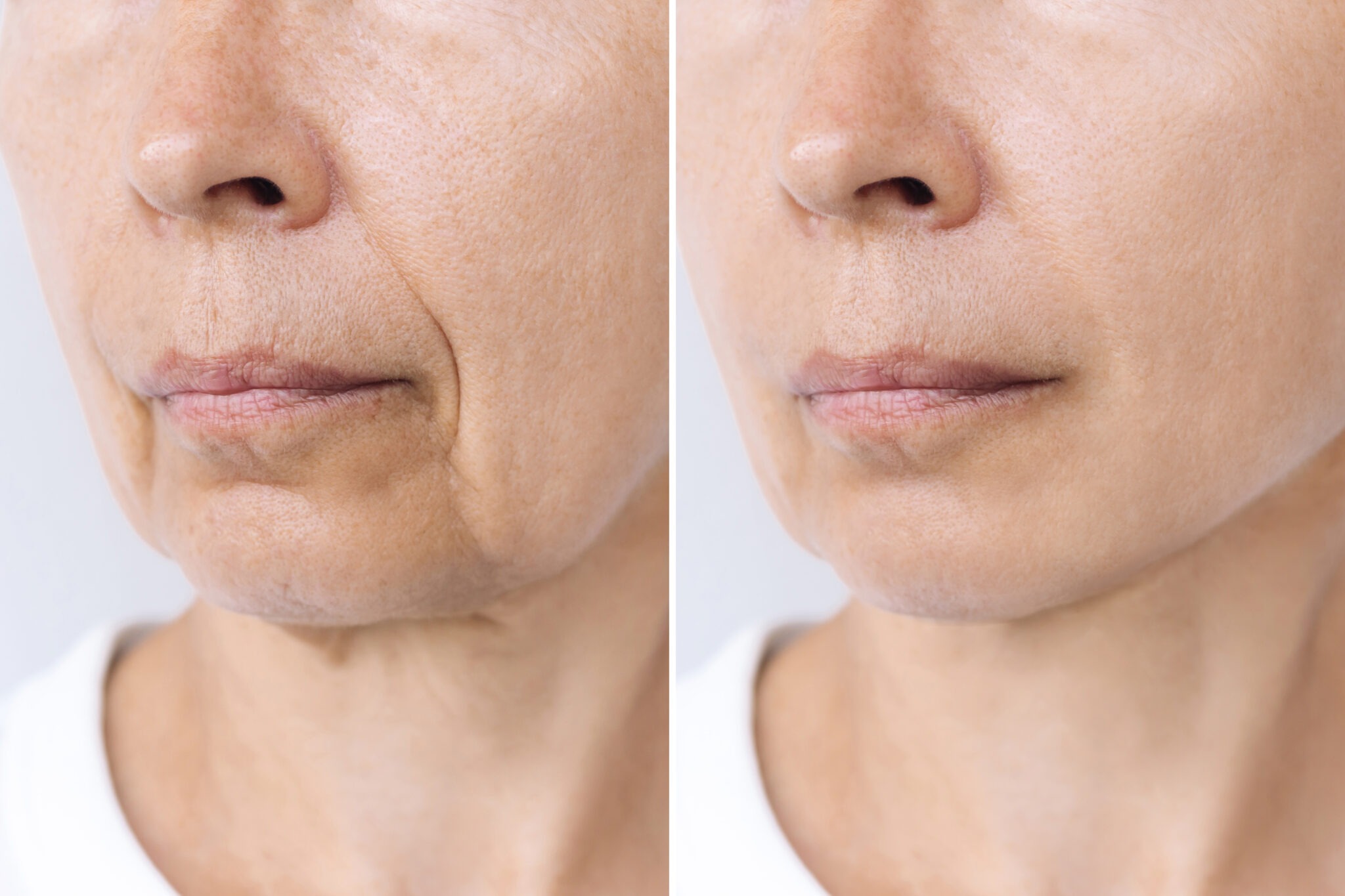 Before and after Radiesse treatment for deep nasolabial folds