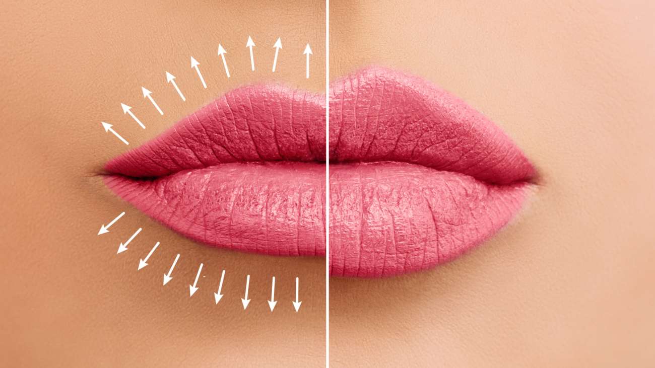 Before and after results of lip filler treatment showing natural volume enhancement.