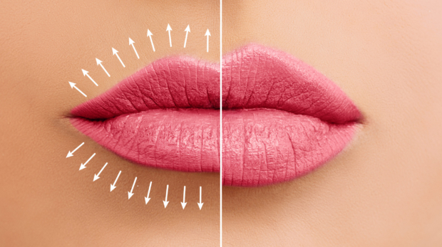 Before and after results of lip filler treatment showing natural volume enhancement.