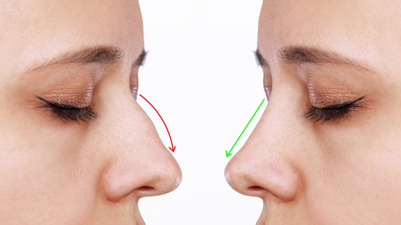 Nose filler treatment results showing before and after