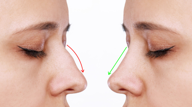 Nose filler treatment results showing before and after