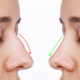 Nose filler treatment results showing before and after