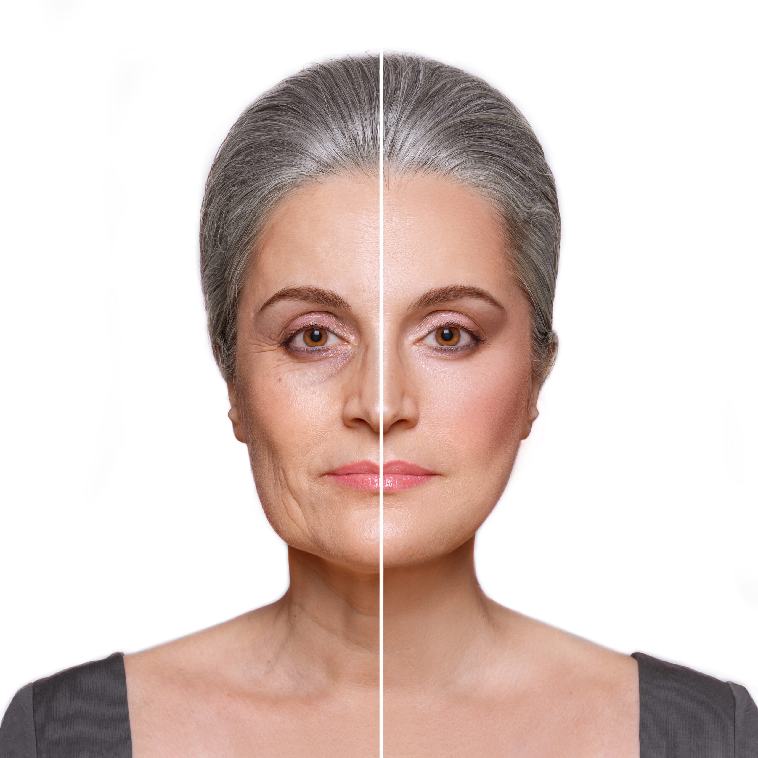 Before and after neuromodulator results