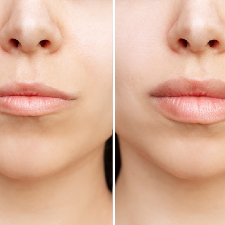 Before and after results of natural lip enhancement with filler