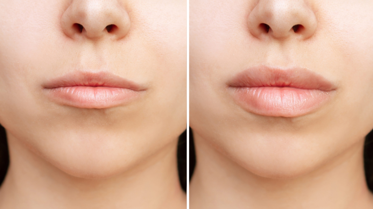 Before and after results of natural lip enhancement with filler