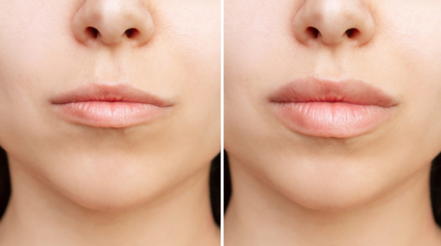 Before and after results of natural lip enhancement with filler