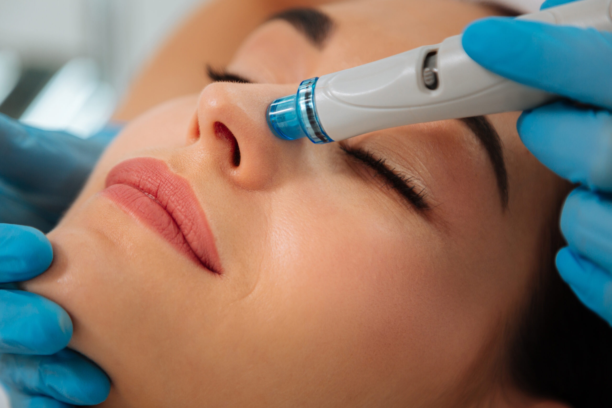 Exosome therapy microneedling treatment for skin regeneration and collagen stimulation.