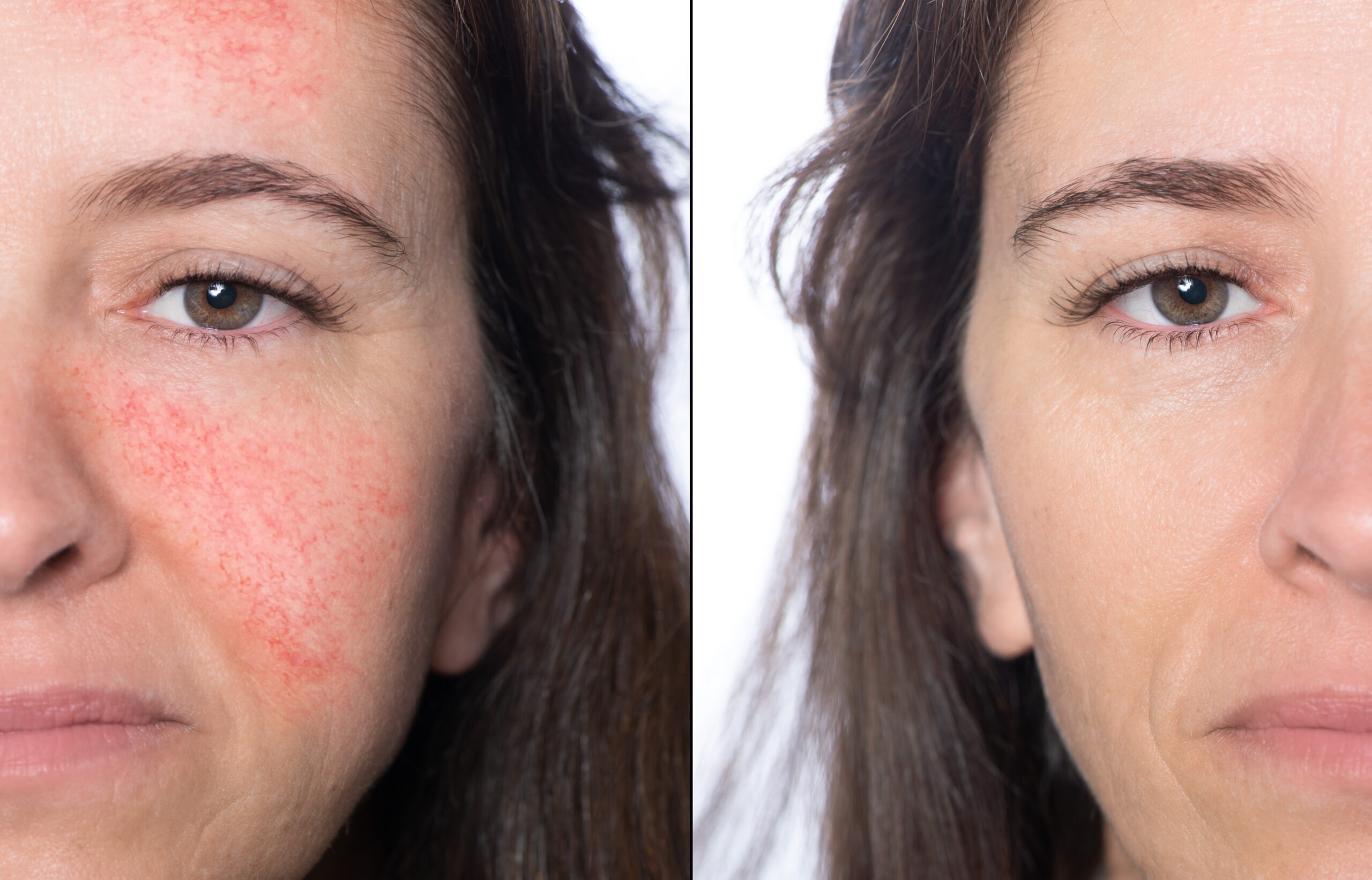 Before and after Laser Genesis skin texture improvement