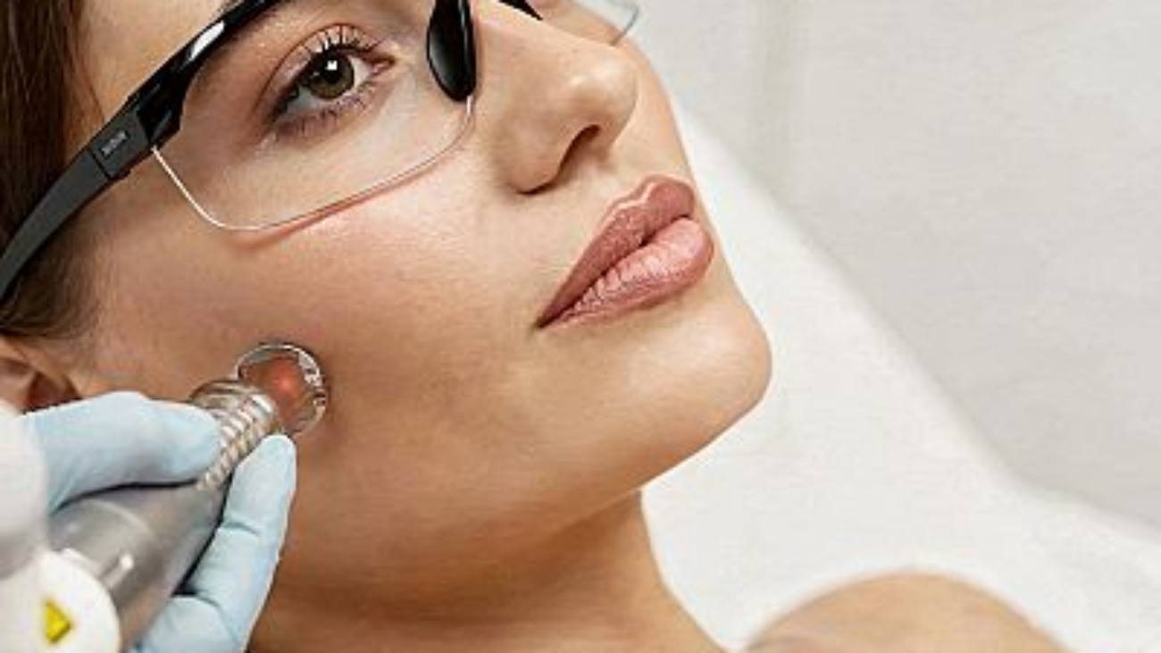 Cosmetologist performing Laser Genesis 1064 nm treatment