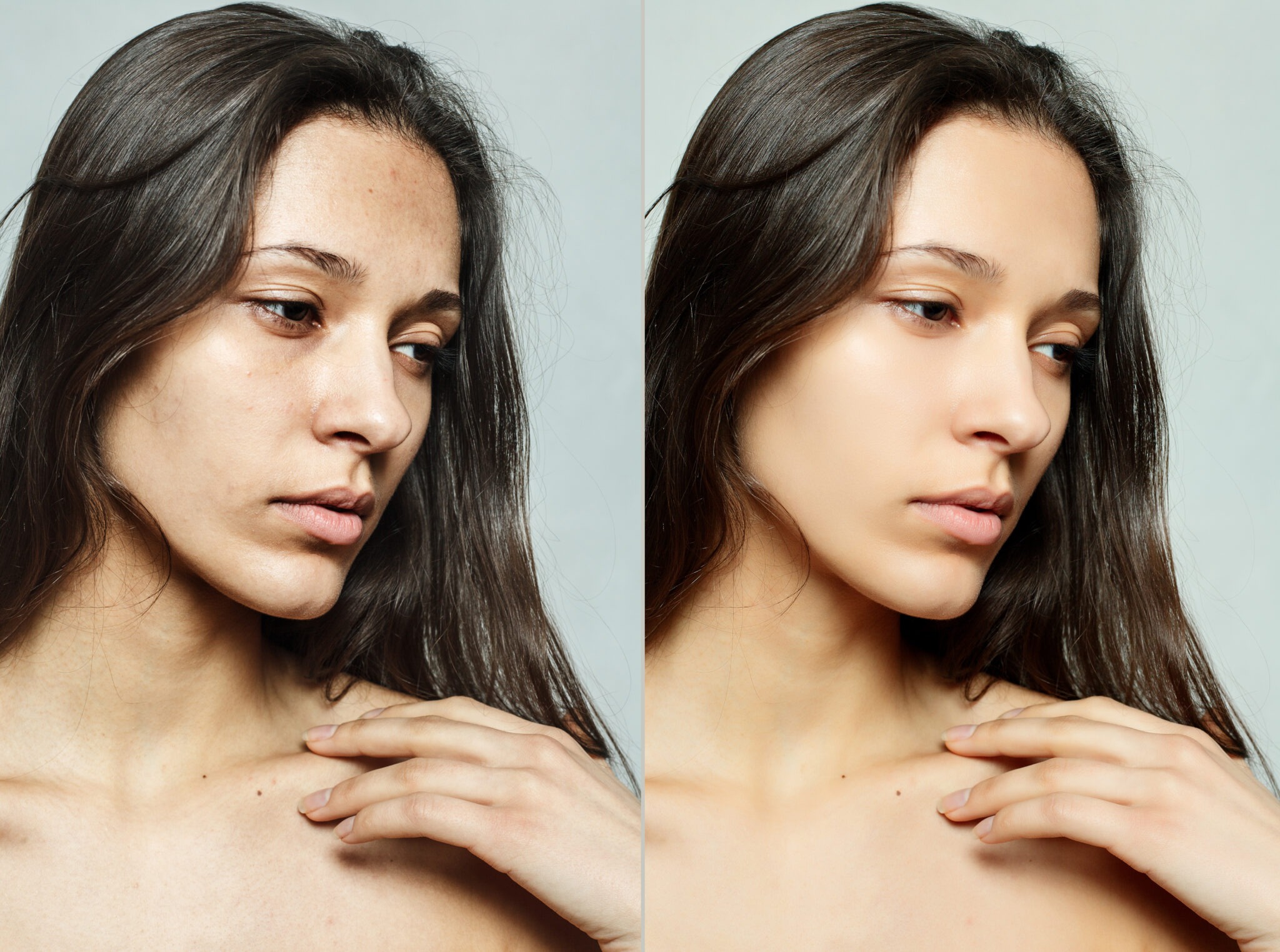 Fraxel before and after skin texture and tone improvement