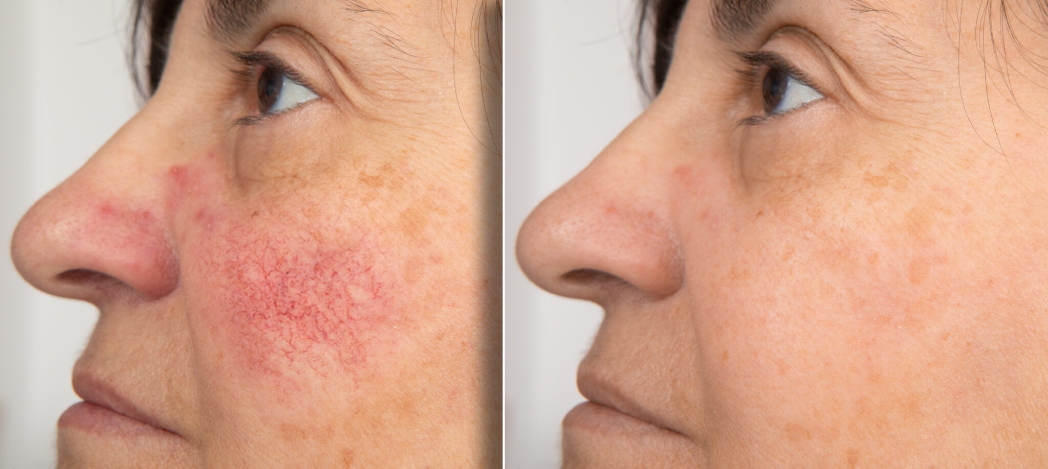 Excel V+ laser before and after redness reduction