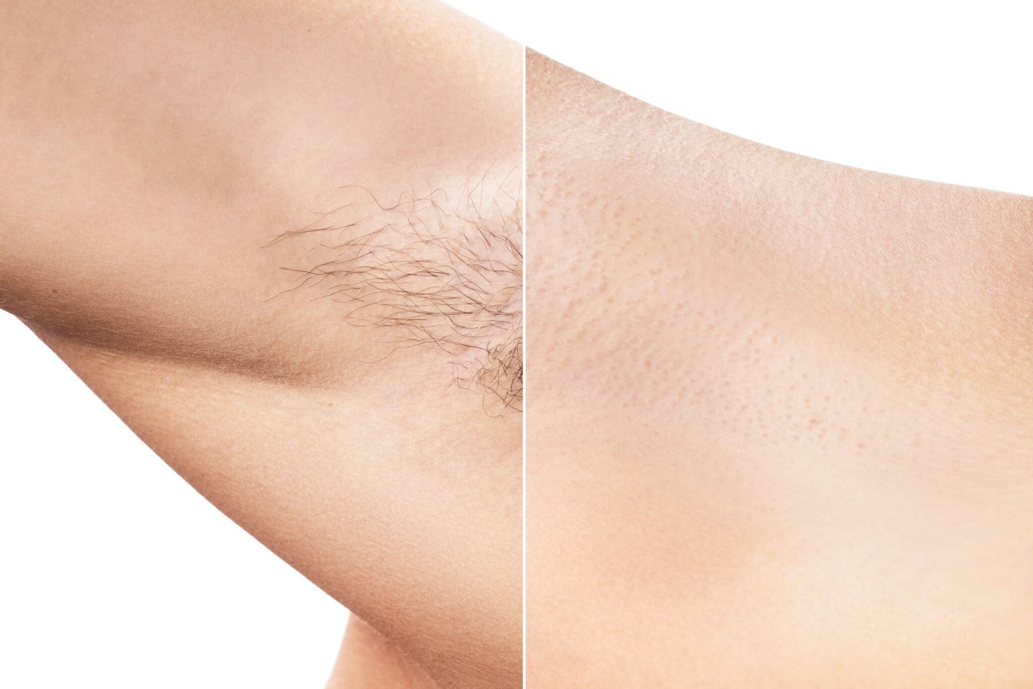 Before and after Splendor X laser hair removal results on underarms