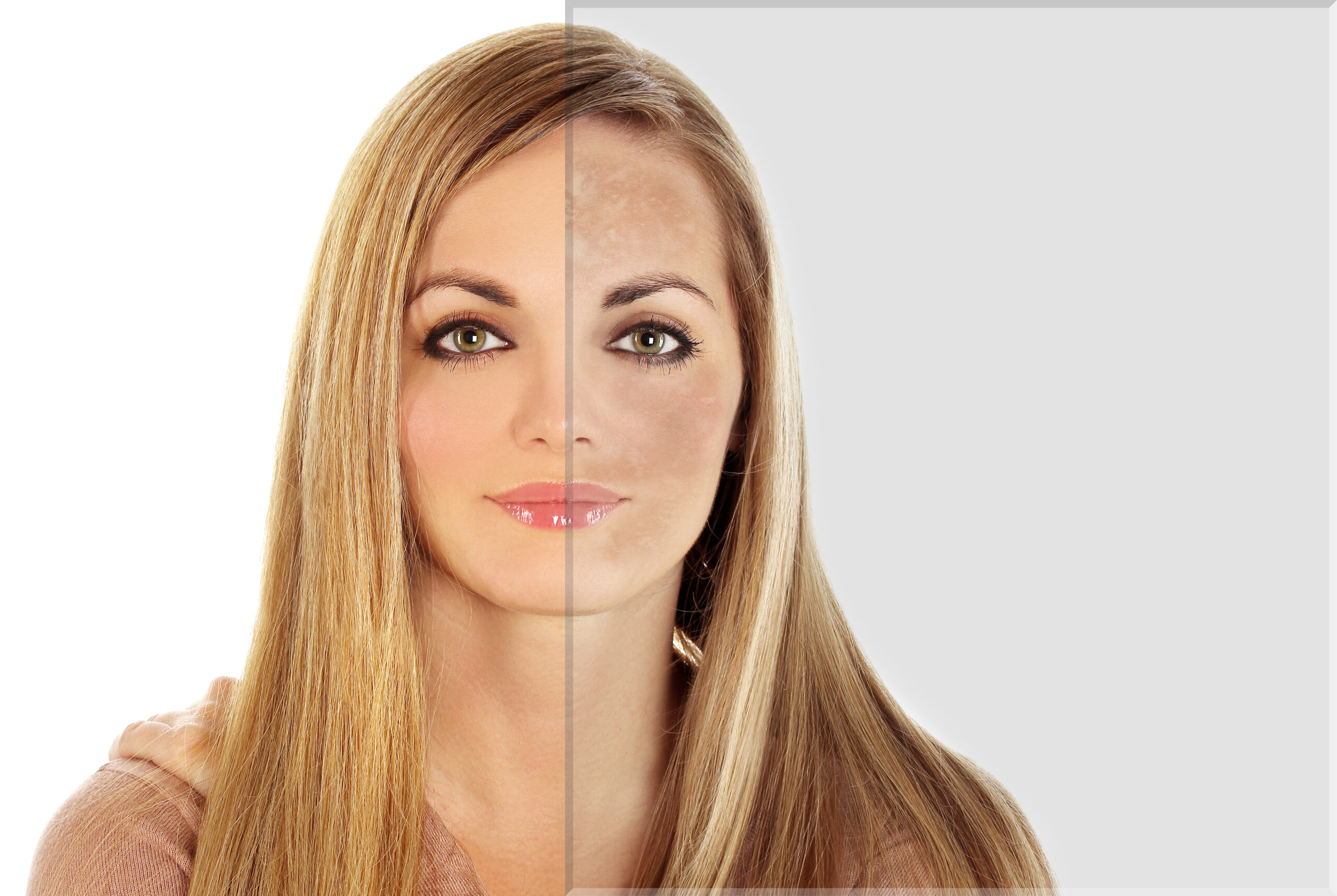 Before and after Pico Laser pigmentation removal results