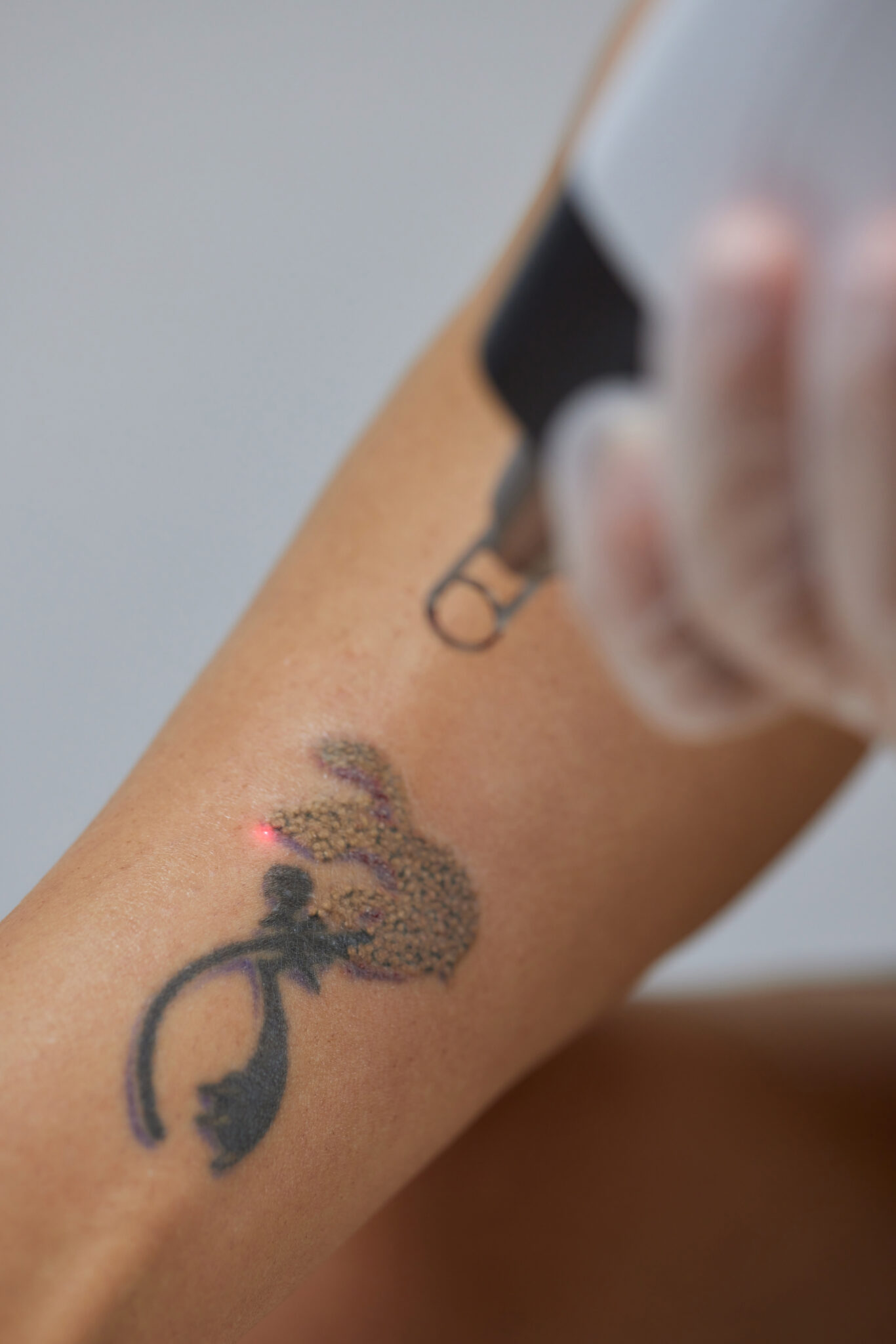 Pico Laser tattoo removal process on the skin