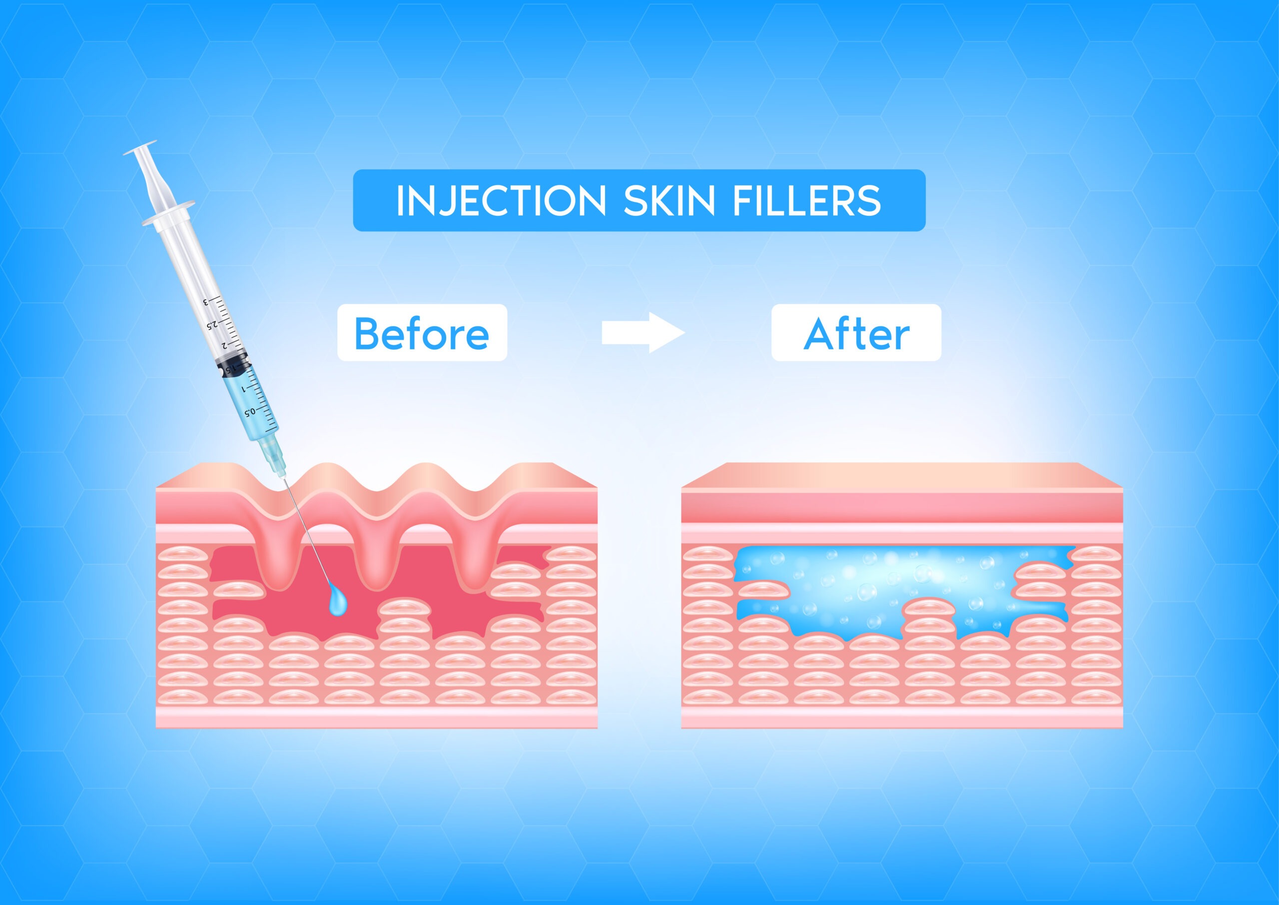 Skin structure and collagen regeneration illustration