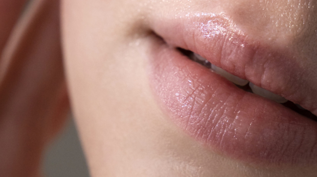 Natural lip augmentation results using hyaluronic acid fillers
