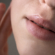Natural lip augmentation results using hyaluronic acid fillers