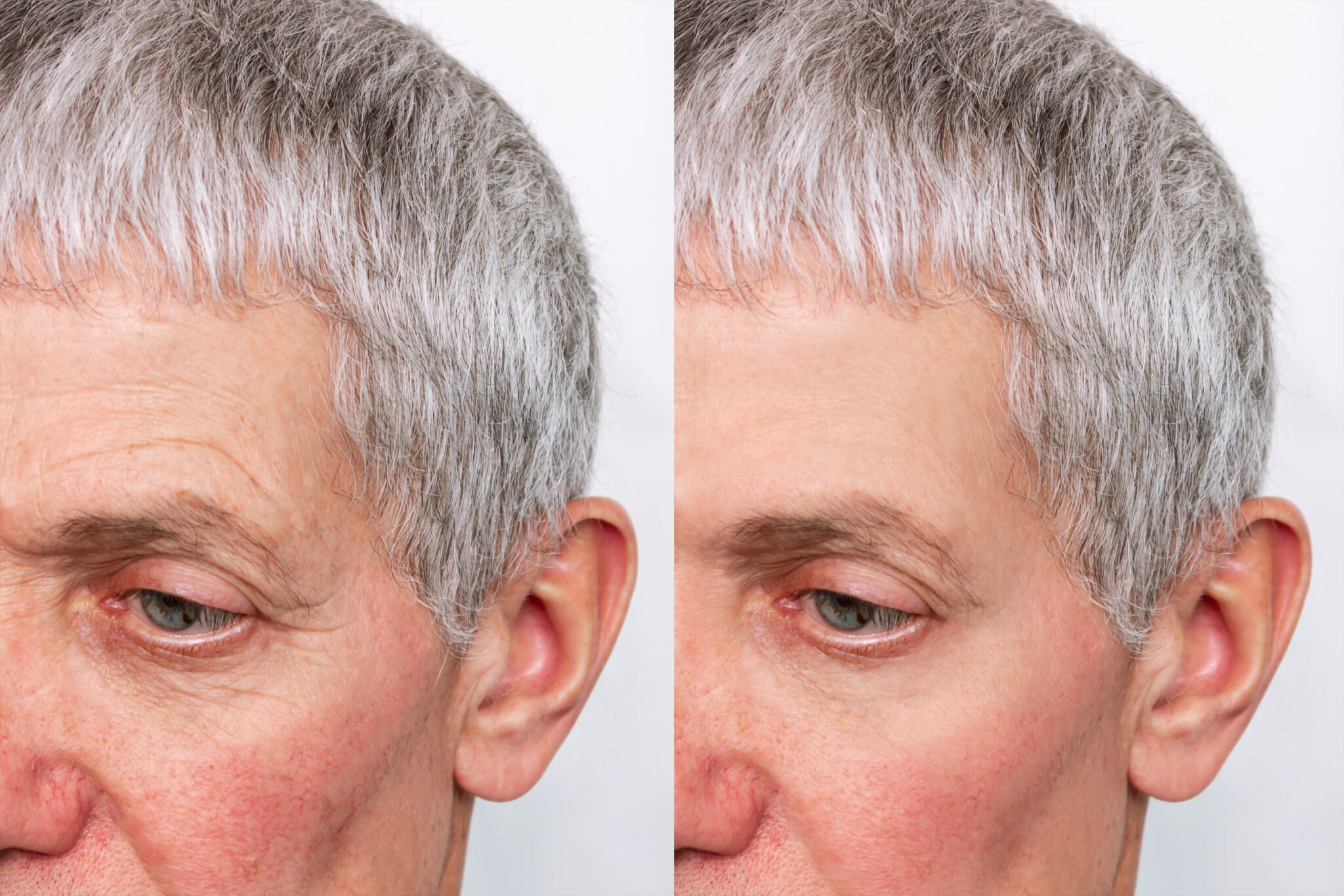 Before and after neuromodulator treatment for fine lines