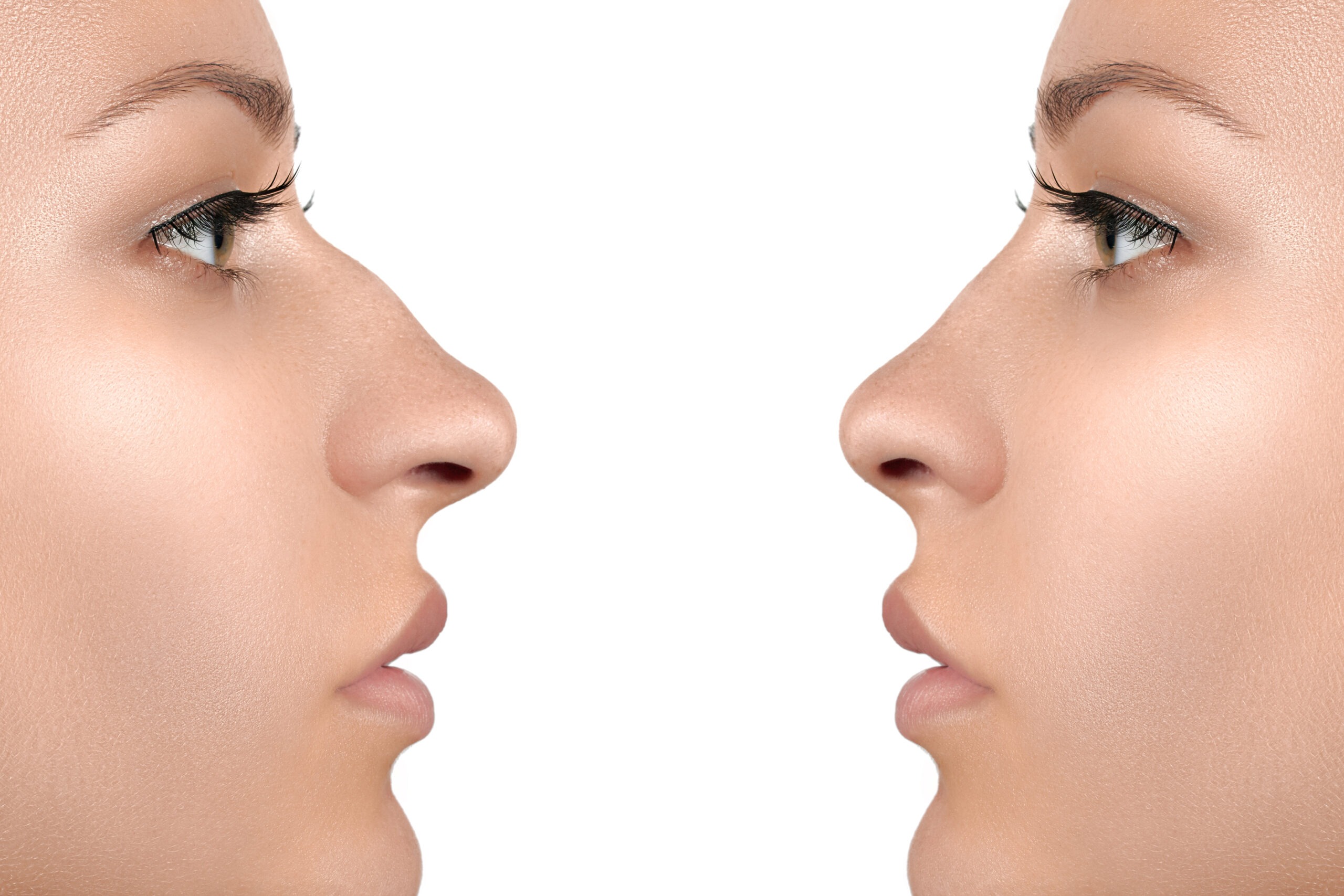Side profile showing subtle nose enhancement with liquid rhinoplasty