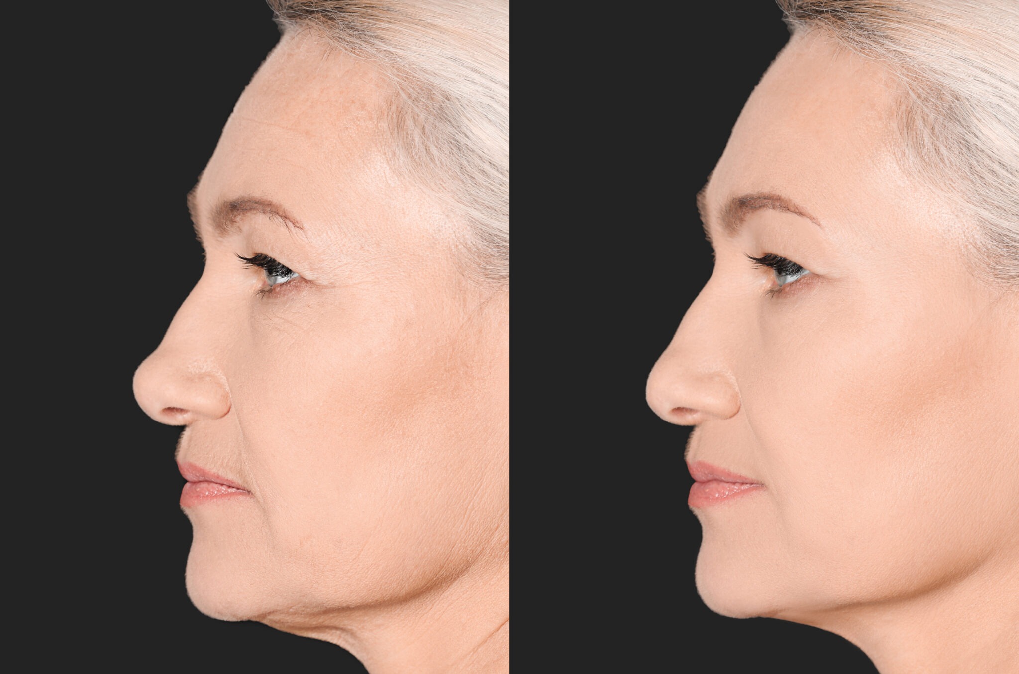 Before and after Radiesse filler for facial lift and contour