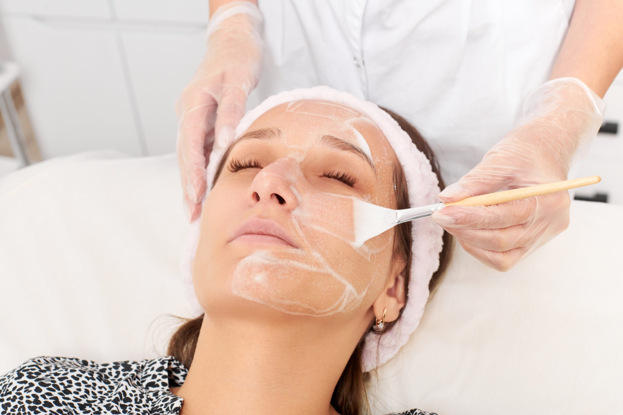 Chemical peel treatment for brightening