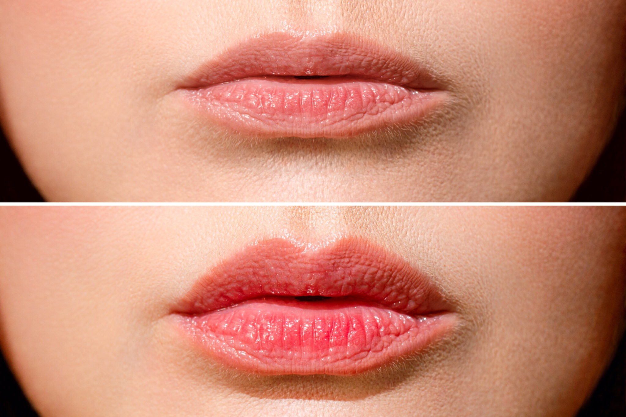 Before and after lip augmentation showing subtle enhancement