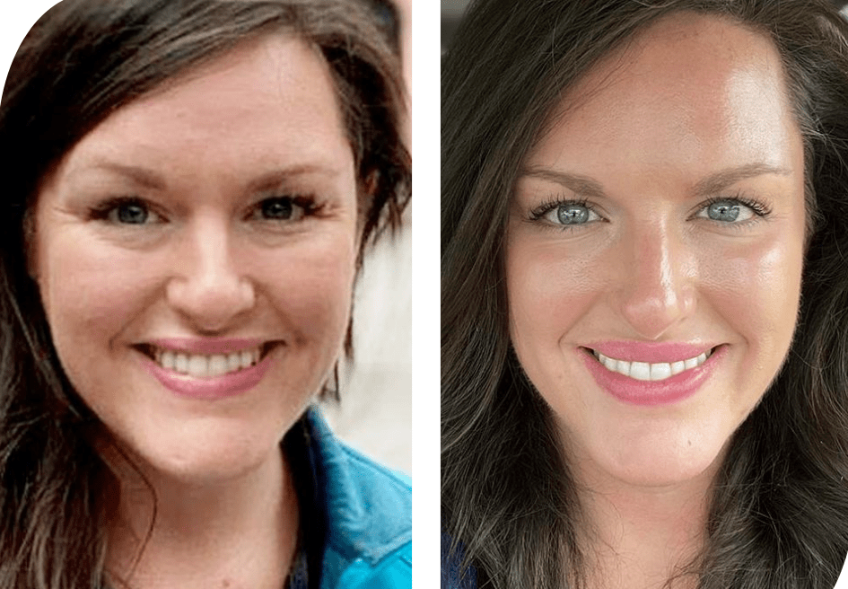 Before and after biostimulatory injectables results