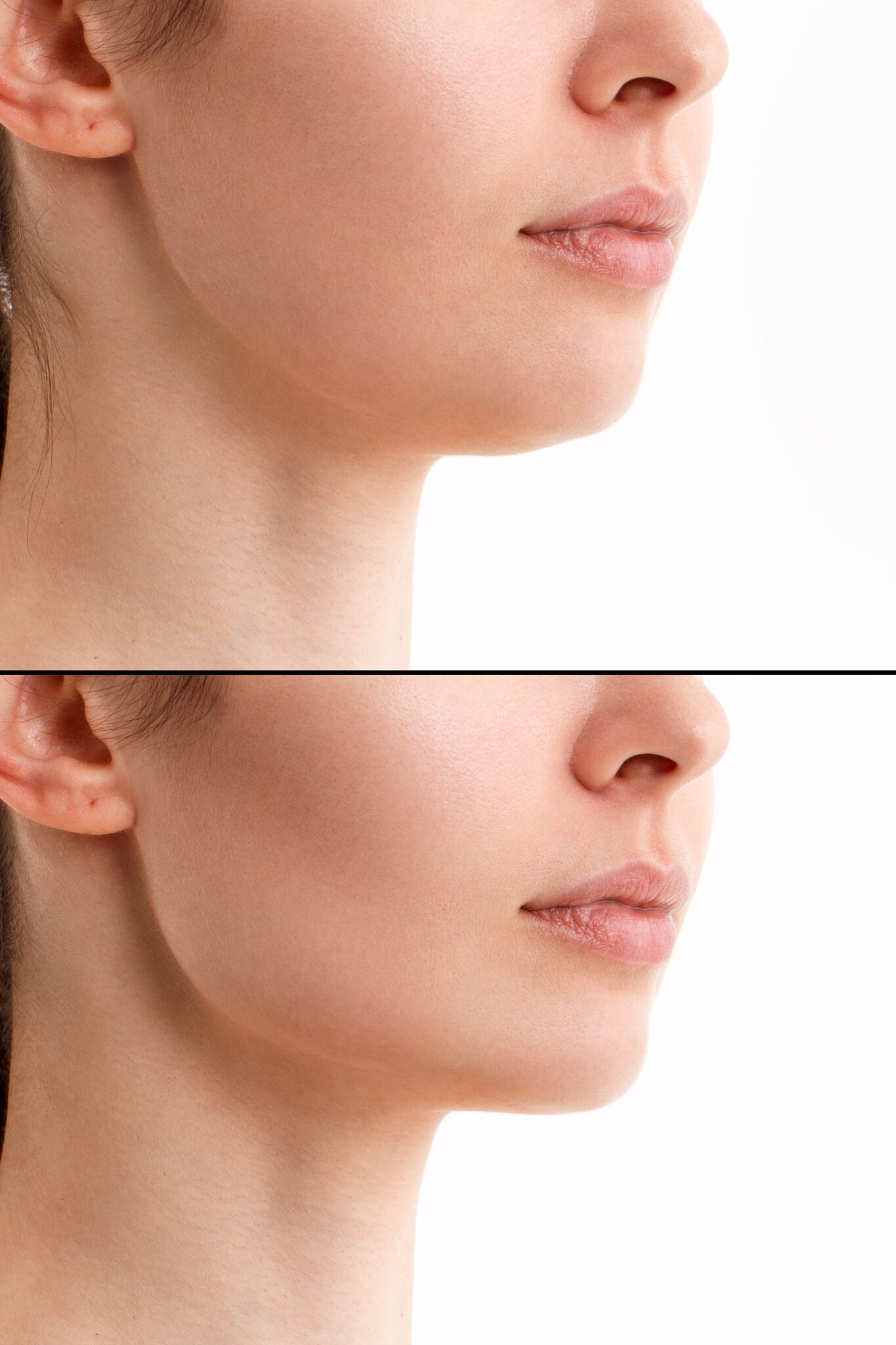 Before and after jawline and chin contouring natural results