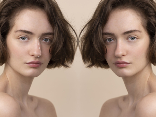 Liquid rhinoplasty before and after results in Riyadh during Ramadan