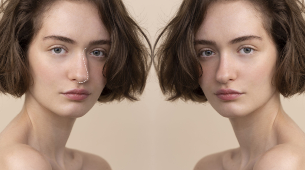 Liquid rhinoplasty before and after results in Riyadh during Ramadan