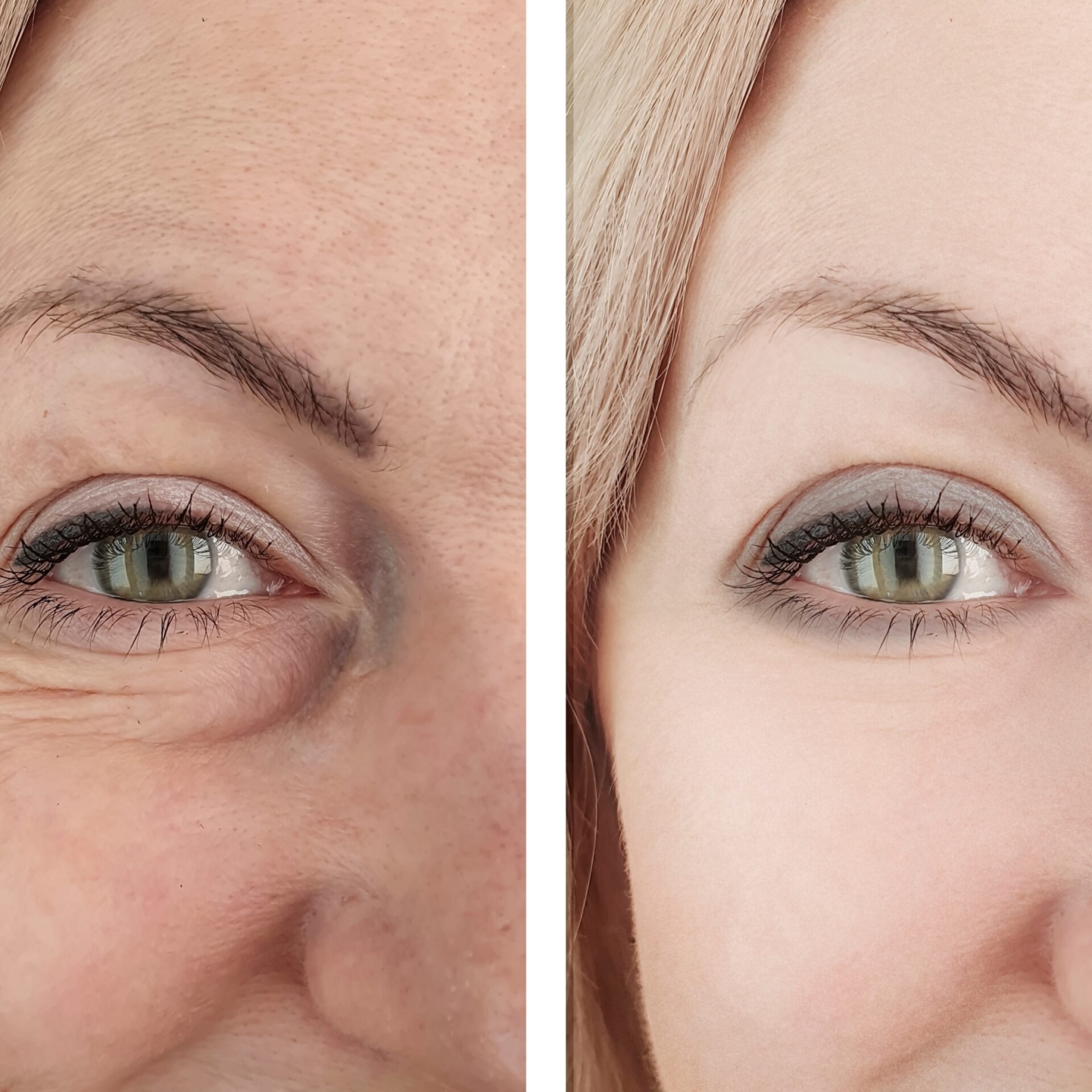 personalized filler before and after results