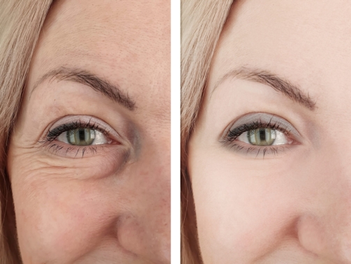 personalized filler before and after results