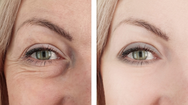 personalized filler before and after results