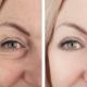 personalized filler before and after results