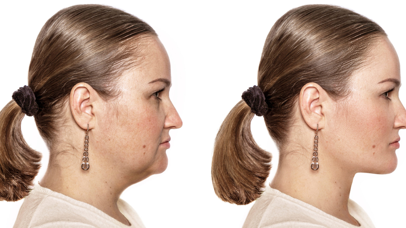 Elite chin and jawline definition before and after results