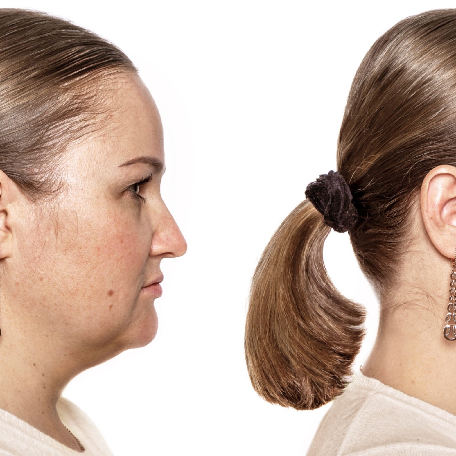 Elite chin and jawline definition before and after results