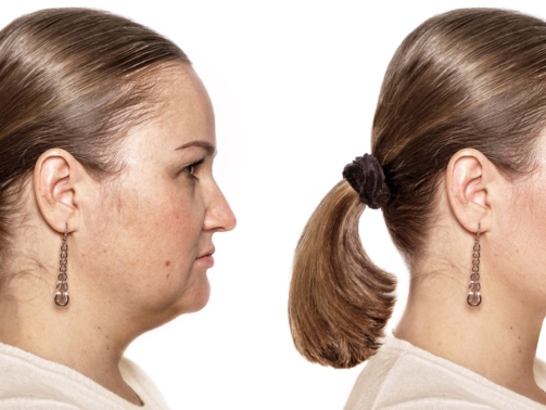 Elite chin and jawline definition before and after results