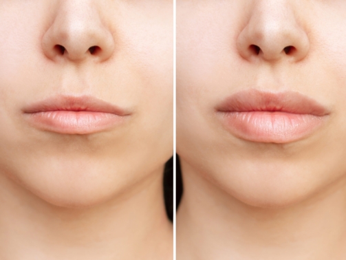 natural lip filler before and after